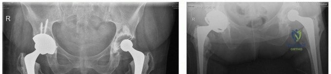 صورة طبية: مراجعة مفصل الورك بالإسمنت داخل الإسمنت: حلول متقدمة لعمليات استبدال الورك المعقدة مع الأستاذ الدكتور محمد هطيف