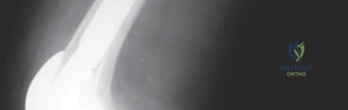 صورة توضيحية لـ جذوع الركبة غير المثبتة بالأسمنت في جراحات المراجعة: دليل شامل للمرضى مع الأستاذ الدكتور محمد هطيف
