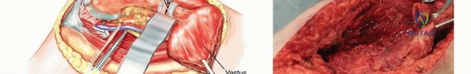 صورة طبية: النقائل العظمية الفخذية: دليل شامل للعلاج واستعادة الوظيفة مع الأستاذ الدكتور محمد هطيف في صنعاء