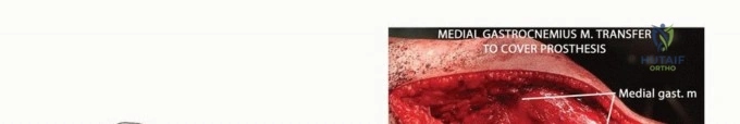 صورة توضيحية لـ معالجة الأورام المعقدة في قصبة الساق القريبة حلول الحفاظ على الأطراف