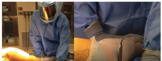 صورة توضيحية لـ سيقان مفصل الفخذ المسامية الموسعة: نجاح مثبت وتثبيت فائق لمفاصل ورك تدوم طويلاً في صنعاء مع الأستاذ الدكتور محمد هطيف