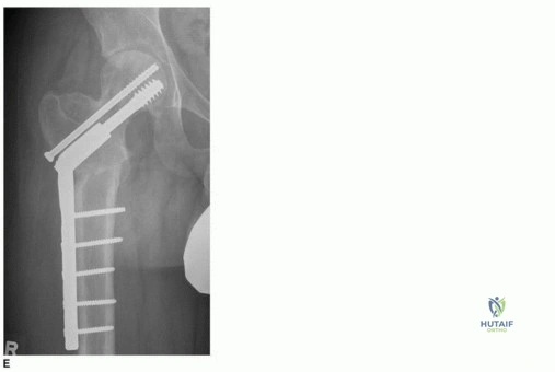 صورة طبية: جراحة قطع العظم حول الحُق وقطع عظم الفخذ: إعادة محاذاة مفصل الورك لراحة دائمة مع الأستاذ الدكتور محمد هطيف