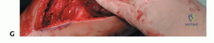 صورة طبية: استئصال أورام الشظية: دليل شامل للعلاج الحديث والحفاظ على الأطراف مع الأستاذ الدكتور محمد هطيف