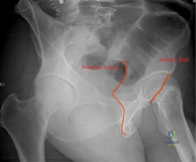 صورة طبية: دليل شامل لكسور وإصابات الجهاز الحركي: رعاية متقدمة في صنعاء مع الأستاذ الدكتور محمد هطيف