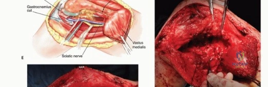 صورة طبية: النقائل العظمية الفخذية: دليل شامل للعلاج واستعادة الوظيفة مع الأستاذ الدكتور محمد هطيف في صنعاء
