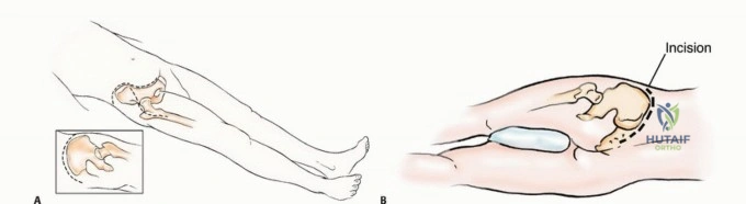 استئصال الورم من عظم الحوض