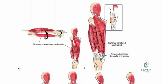 صورة توضيحية لـ استئصال ساركوما العضلة الرباعية مع الحفاظ على الطرف: دليل شامل للمرضى مع الأستاذ الدكتور محمد هطيف في صنعاء