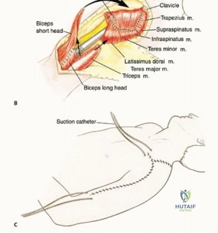 صورة توضيحية لـ استئصال الجزء القريب من عظم العضد بتقنيات الحفاظ على الطرف: دليل شامل للمرضى مع الأستاذ الدكتور محمد هطيف