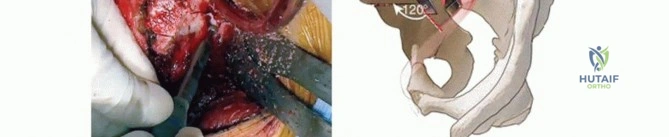 صورة طبية: استعادة صحة مفصل الفخذ جراحة قطع العظم الحوضي لعلاج خلل التنسج الحُقّي في صنعاء