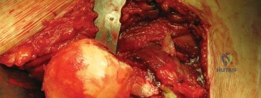 نهاية العملية الجراحية
