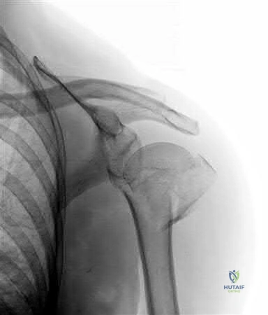 Illustration of elbow orthopedic mcqs - Dr. Mohammed Hutaif
