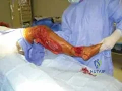 تفاصيل مرئية 24 - التثبيت الخارجي للقصبة: هكذا يتم وضع مسمارين لكسور معقدة