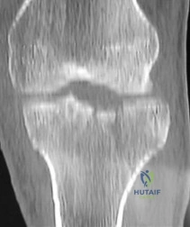 تشريح -الكتف المتجمد