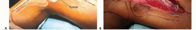 صورة توضيحية لـ النقائل العظمية الفخذية: دليل شامل للعلاج واستعادة الوظيفة مع الأستاذ الدكتور محمد هطيف في صنعاء