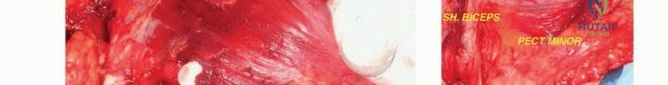 صورة توضيحية لـ استئصال الجزء القريب من عظم العضد بتقنيات الحفاظ على الطرف: دليل شامل للمرضى مع الأستاذ الدكتور محمد هطيف
