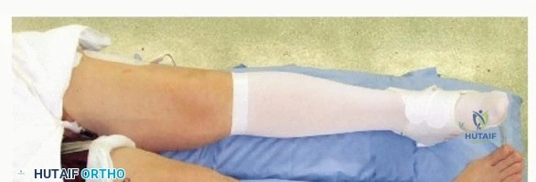 صورة توضيحية لـ قطع عظم الظنبوب العالي: إعادة محاذاة الركبة لتخفيف دائم لآلامها مع الأستاذ الدكتور محمد هطيف