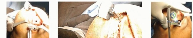 صورة طبية: استبدال مفصل الركبة الجزئي: حل متقدم لآلام الركبة المستمرة مع الأستاذ الدكتور محمد هطيف