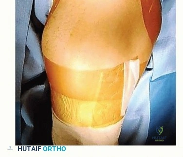 صورة طبية: استعادة صحة مفصل الفخذ جراحة قطع العظم الحوضي لعلاج خلل التنسج الحُقّي في صنعاء