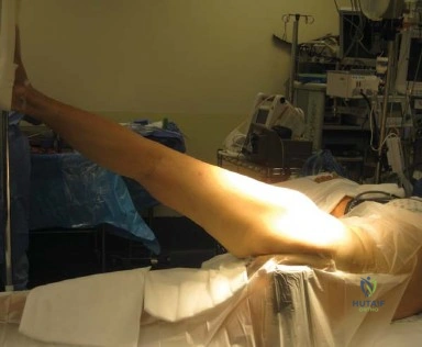 صورة توضيحية لـ المدخل الخلفي الجانبي لجراحة استبدال مفصل الورك الكلي: دليل شامل للمرضى في صنعاء مع الأستاذ الدكتور محمد هطيف