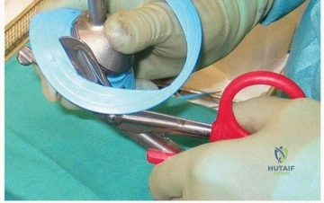 تخطيط ما قبل الجراحة لاختيار حجم الغرسة المناسب