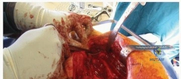 صورة طبية: بضع المدور الكبير الممتد: حلول متقدمة لمراجعة مفصل الورك في صنعاء مع الأستاذ الدكتور محمد هطيف