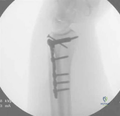 صورة طبية: دليل شامل لكسور وإصابات الجهاز الحركي: رعاية متقدمة في صنعاء مع الأستاذ الدكتور محمد هطيف