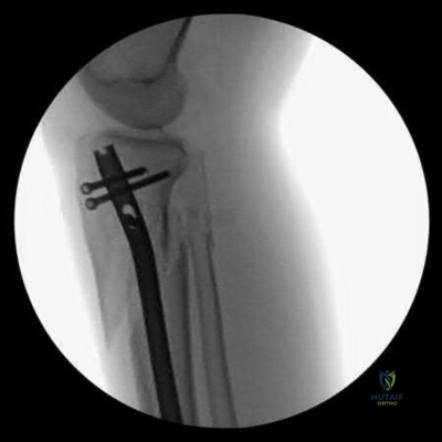 صورة طبية: دليل شامل لكسور وإصابات الجهاز الحركي: رعاية متقدمة في صنعاء مع الأستاذ الدكتور محمد هطيف