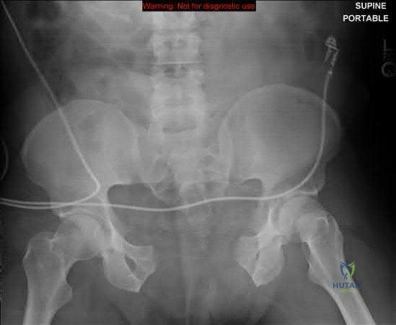 صورة طبية: دليل شامل لكسور وإصابات الجهاز الحركي: رعاية متقدمة في صنعاء مع الأستاذ الدكتور محمد هطيف