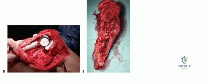 صورة طبية: مرض العظام النقيلي: دليل شامل للمرضى حول التخطيط الجراحي والعلاج لمنع الفشل مع الأستاذ الدكتور محمد هطيف في صنعاء