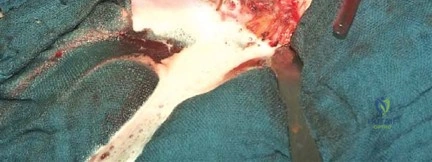 صورة طبية: جراحة استبدال مفصل الورك الملتهب في مرحلة واحدة: حل فعال وشامل مع الأستاذ الدكتور محمد هطيف