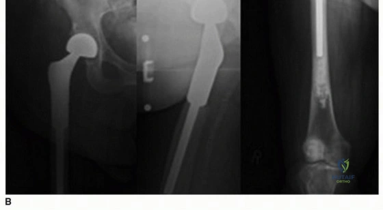 صورة توضيحية لـ دليلك الشامل لإصابات وأمراض العظام والمفاصل: العلاج والوقاية مع الأستاذ الدكتور محمد هطيف في صنعاء