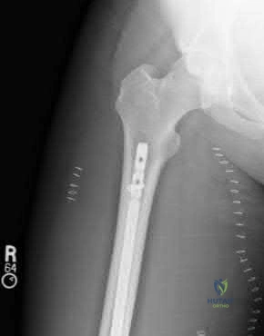 صورة طبية: دليل شامل لكسور وإصابات الجهاز الحركي: رعاية متقدمة في صنعاء مع الأستاذ الدكتور محمد هطيف