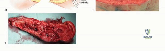 صورة طبية: النقائل العظمية الفخذية: دليل شامل للعلاج واستعادة الوظيفة مع الأستاذ الدكتور محمد هطيف في صنعاء