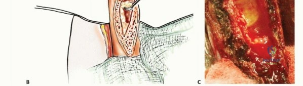 صورة طبية: جراحة نقائل عظم العضد: دليل شامل لاستعادة الوظيفة وتخفيف الألم في اليمن مع الأستاذ الدكتور محمد هطيف