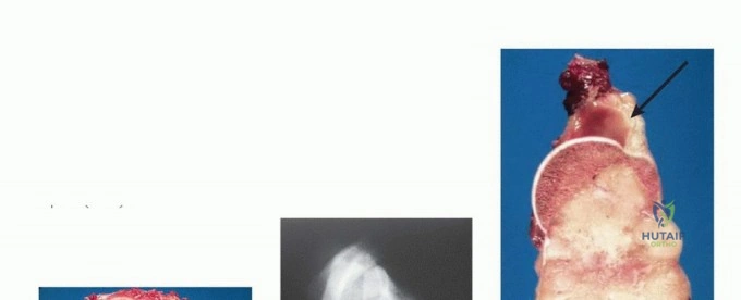 صورة طبية: استئصال الجزء القريب من عظم العضد بتقنيات الحفاظ على الطرف: دليل شامل للمرضى مع الأستاذ الدكتور محمد هطيف