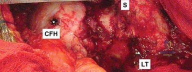 صورة طبية: إتقان توازن الأنسجة الرخوة لمفصل ورك صناعي مثالي: دليل شامل للمرضى مع الأستاذ الدكتور محمد هطيف