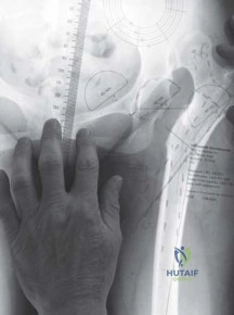 صورة طبية: استبدال مفصل الورك الكلي الناجح في خلل التنسج النمائي للورك: دليل شامل من الأستاذ الدكتور محمد هطيف