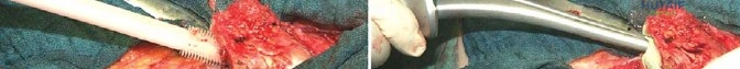 صورة طبية: جراحة استبدال مفصل الورك الملتهب في مرحلة واحدة: حل فعال وشامل مع الأستاذ الدكتور محمد هطيف