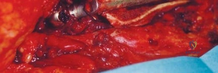 صورة طبية: علاج عدوى مفصل الورك الصناعي: دليل شامل لمراجعة المفصل على مرحلتين مع الأستاذ الدكتور محمد هطيف في صنعاء