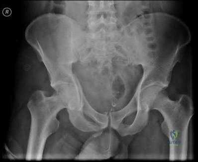 صورة طبية: دليل شامل لكسور وإصابات الجهاز الحركي: رعاية متقدمة في صنعاء مع الأستاذ الدكتور محمد هطيف