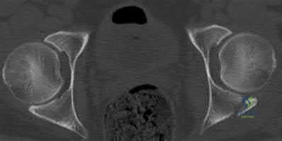 صورة طبية: دليل شامل لكسور وإصابات الجهاز الحركي: رعاية متقدمة في صنعاء مع الأستاذ الدكتور محمد هطيف