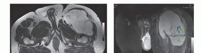 صورة طبية: استئصال ساركوما العضلة الرباعية مع الحفاظ على الطرف: دليل شامل للمرضى مع الأستاذ الدكتور محمد هطيف في صنعاء