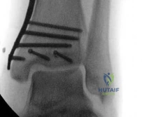 صورة طبية: كسر قصبة الساق الممتد إلى مفصل الكاحل (البلافون): أسرار العلاج بالمسمار النخاعي مع الأستاذ الدكتور محمد هطيف