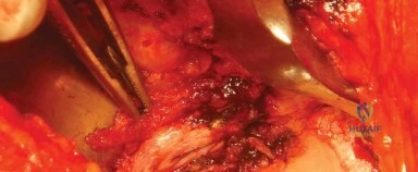 صورة طبية: المدخل الخلفي الجانبي لجراحة استبدال مفصل الورك الكلي: دليل شامل للمرضى في صنعاء مع الأستاذ الدكتور محمد هطيف