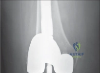 صورة طبية: إتقان موازنة الفجوة في مراجعة استبدال مفصل الركبة: تجنب الأخطاء الشائعة واستعادة الحركة مع الأستاذ الدكتور محمد هطيف