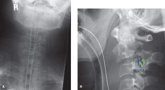 صورة توضيحية لـ تنكس القطعة المجاورة للعمود الفقري: دليلك الشامل للتشخيص والعلاج في صنعاء مع الأستاذ الدكتور محمد هطيف