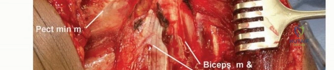 إغلاق الجرح التجميلي