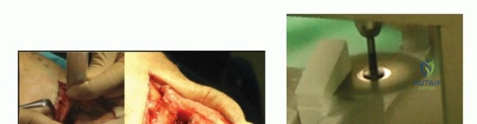 صورة طبية: قطع عظم الظنبوب العالي: إعادة محاذاة الركبة لتخفيف دائم لآلامها مع الأستاذ الدكتور محمد هطيف