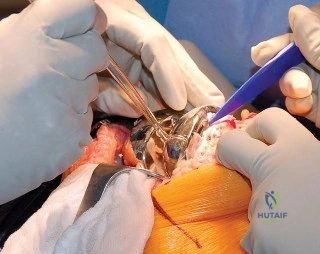 صورة طبية: إتقان موازنة الفجوة في مراجعة استبدال مفصل الركبة: تجنب الأخطاء الشائعة واستعادة الحركة مع الأستاذ الدكتور محمد هطيف