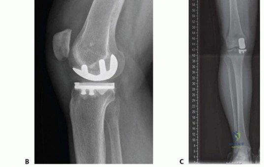 صورة طبية: استبدال مفصل الركبة الجزئي: حل متقدم لآلام الركبة المستمرة مع الأستاذ الدكتور محمد هطيف